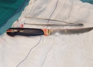 القصة الكاملة لاستخراج سكين مطبخ من معدة مريض بالدقهلية