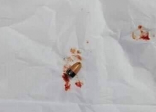صور| طالب يجري عملية جراحية لاستخراج سماعة علقت بأذنه.. "كان عاوز يغش"