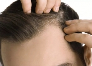 لتجنب الصلع المبكر.. 6 وصفات طبيعية لعلاج قشرة الشعر في المنزل