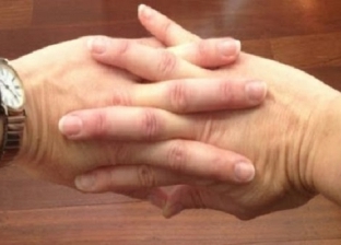 هل «فرقعة الأصابع» تقلل التهاب المفاصل أم تسبب الخشونة؟.. اعرف رأي الأطباء