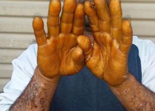 مرض جلدي يصيب 7 عمال في الشرقية.. والكشف الطبي يعجز عن التشخيص