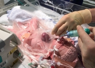 بالفيديو| تحدث مرة كل 126 ألف حالة.. ولادة طفلة بقلب خارج جسدها
