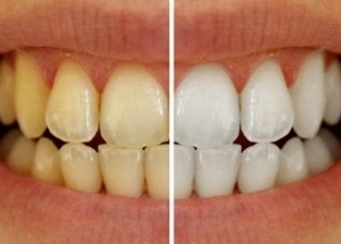 3 عادات شائعة تؤدي إلى اصفرار الأسنان والتهاب اللثة.. احذر ممارستها