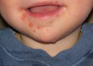 فيروس متلازمة الفم واليد والقدم يصيب الأطفال أقل من 5 سنوات.. ما الأعراض؟