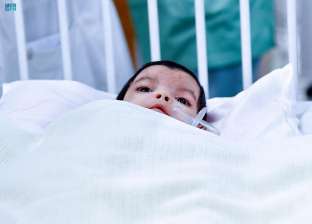 جراحة عاجلة لـ التوأم الطفيلي اليمني بمشاركة 25 طبيبا: طفلة بـ4 سيقان