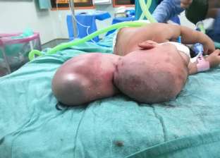 جراحة نادرة.. استئصال ورم من رأس طفل بمستشفى المنصورة