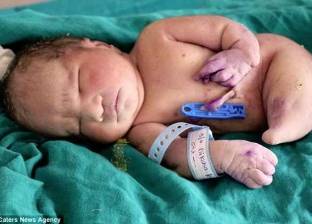 بالصور| ولادة طبيعية لـ"طفل يشبه السمكة" في الهند
