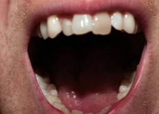 "صرير الأسنان" ليس مجرد صوتا مزعجا فقط.. احذر عواقبه الصحية
