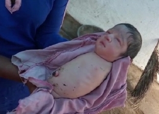صور.. حالة نادرة تحدث مرة كل 100 ألف.. ولادة طفلة بدون أي أطراف