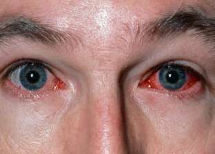 «العين الوردية» أحدث أعراض متحور أوميكرون.. الفيروس يخترق العين