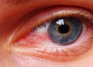 تحذير هام من بكتيريا تسبب العمى: تظهر على هيئة حبوب داخل جفن العين