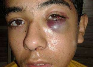 إصابة طالب بكسر في الجمجمة: ضربه زميله بـ"البوكس" داخل الفصل