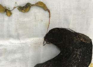 «تزن 1.5 كيلو».. أطباء يستخرجون كتلة شعر من معدة طفلة هندية (صور)