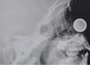 استخراج عملة معدنية من أنف طفل بعد جراحة 20 دقيقة في مكة