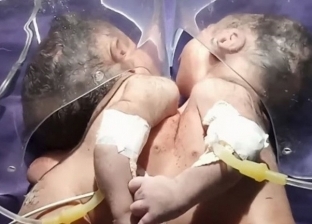 بالفيديو| حالة نادرة.. ولادة طفلتين بقلب واحد في الهند