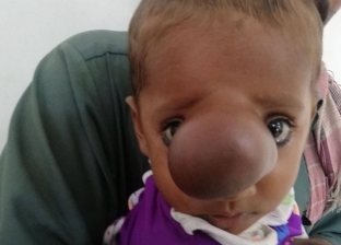 صور| طفل يعاني من ورم نادر في الأنف