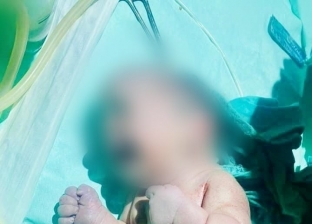 ولادة نادرة لطفل على شكل «حورية البحر» في الأقصر (صورة)