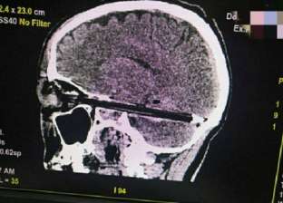 أطباء يستخرجون قلم من جمجة رجل «اخترق عينه ووصل إلى المخ»