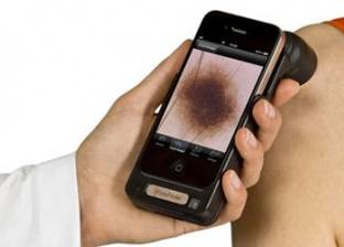 "هواتف ذكية" للكشف عن سرطان الجلد