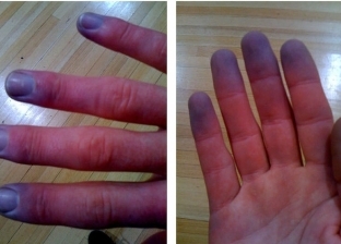انتبه.. تغير لون الأصابع للأزرق أو الأبيض في الشتاء من أعراض هذا المرض