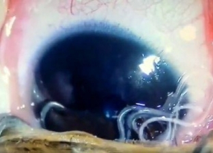 بالصور| 11 نوعا من الديدان داخل عين طفل صيني