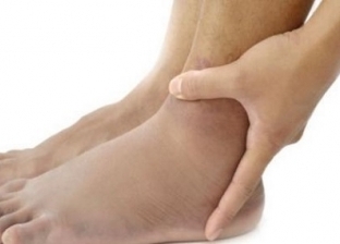 طبيب يكشف عن أسباب تورم القدمين عند كبار السن