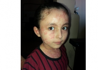 الطفلة بيان الفلسطينية في طريقها للعلاج بمصر: استجاب لها الرئيس السيسي