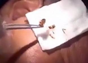 بالفيديو| طبيب يزيل "صرصار" من أذن رجل