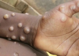 إصابة أول طفلة بفيروس جدري القرود في ألمانيا