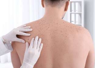 سرطان الجلد.. تعرف على أعراض المرض الخطير الناتج عن التعرض للشمس