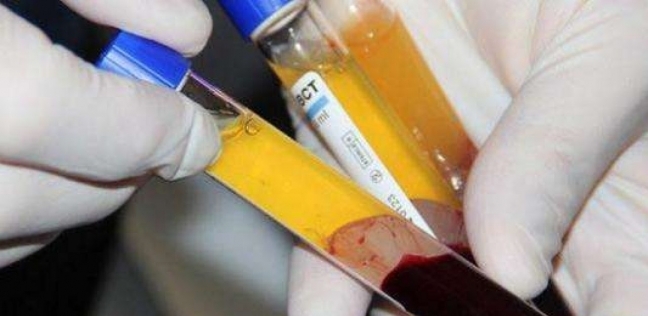 بلازما الدم للمتعافين من فيروس كورونا