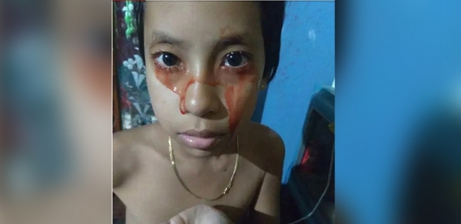 طفلة تبكي وتتعرق دماء بسبب حالة مرضية غريبة