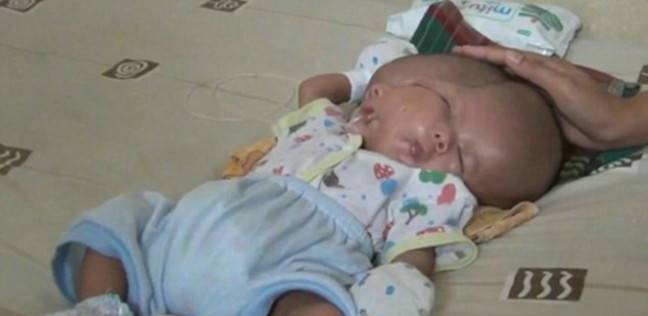 ولادة طفل ذو وجهين في إندونيسيا