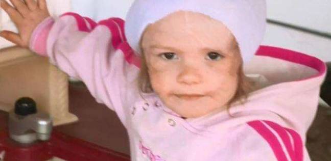 طفلة 3 سنوات تفقد أذنها بعد هجوم كلب مفترس عليها