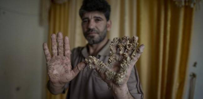 "جروت" الفلسطيني.. يعاني من مرض نادر جعله "رجل الشجرة"