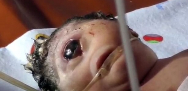 ولادة طفلة إندونيسية ضخمة ذات عين واحدة