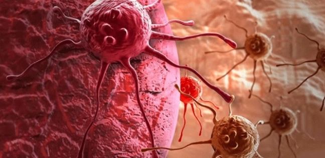 خلايا مصابة بالسرطان - أرشيفية