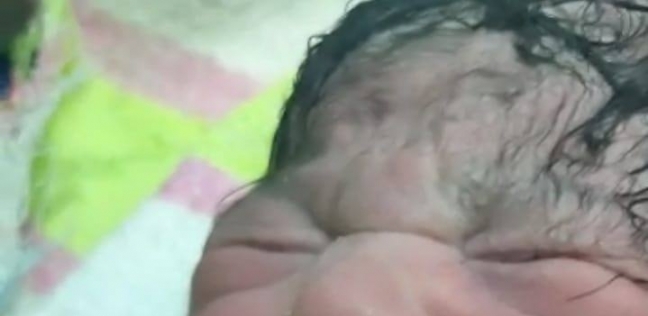 أغرب حالات الولادة في مصر طفلة بسنتين