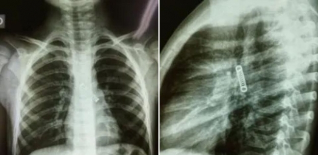 الأشعة تكشف جسم غريب داخل جسم الطفل