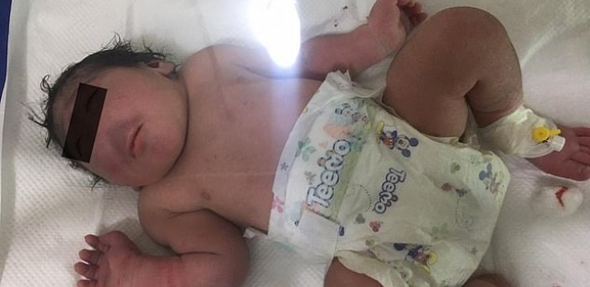 ولادة طفل بدون أنف في العراق
