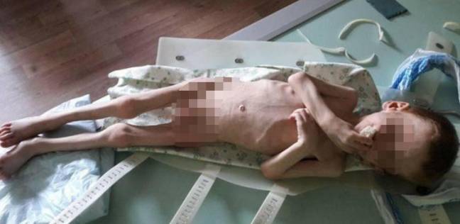صورة مروعة لطفل تركه والداه يموت جوعا فصار مجرد جلد على عظم