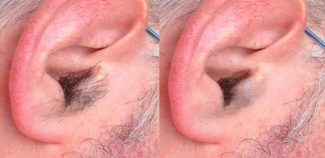 دراسة: كثافة شعر الأذن قد تكون مؤشرًا على مرض قاتل