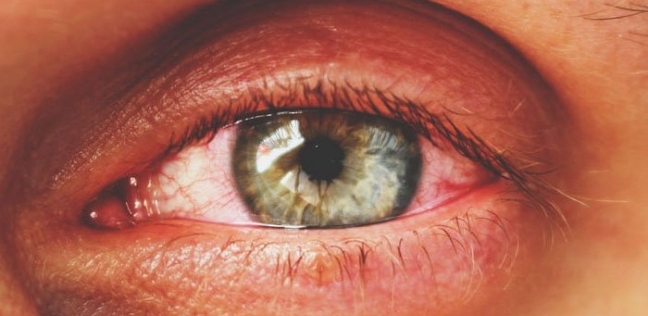 "موجودة بقالها كتير".. العثور  على بكتيريا في العين تحميها من العمى