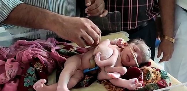 ولادة طفلة في الهند تحمل اربعة ارجل وثلاثة من الأيد