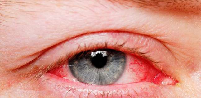 التهاب العيون