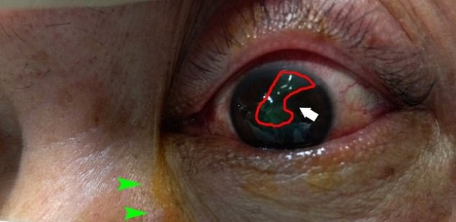 كمامة تصيب رجل بقطع في قرنية العين