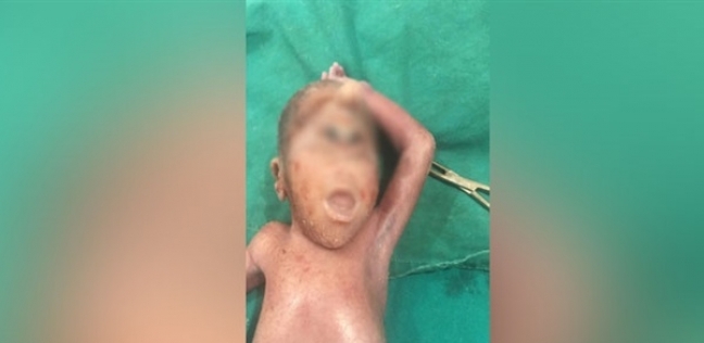 ولادة طفل بعين واحدة في محافظة الأقصر