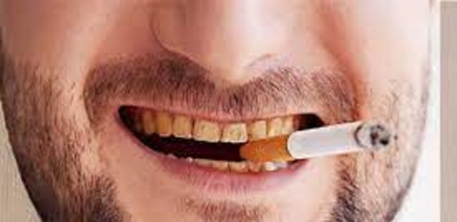 أضرار التدخين على الأسنان