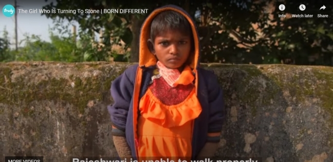 طفلة هندية تعانى من مرض نادر يجعل جلدها مثل الحجارة