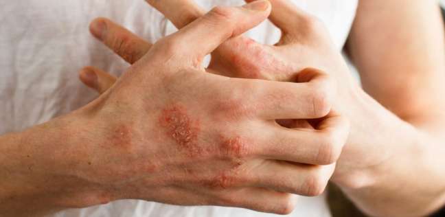 أمراض جلدية شائعة في فصل الشتاء